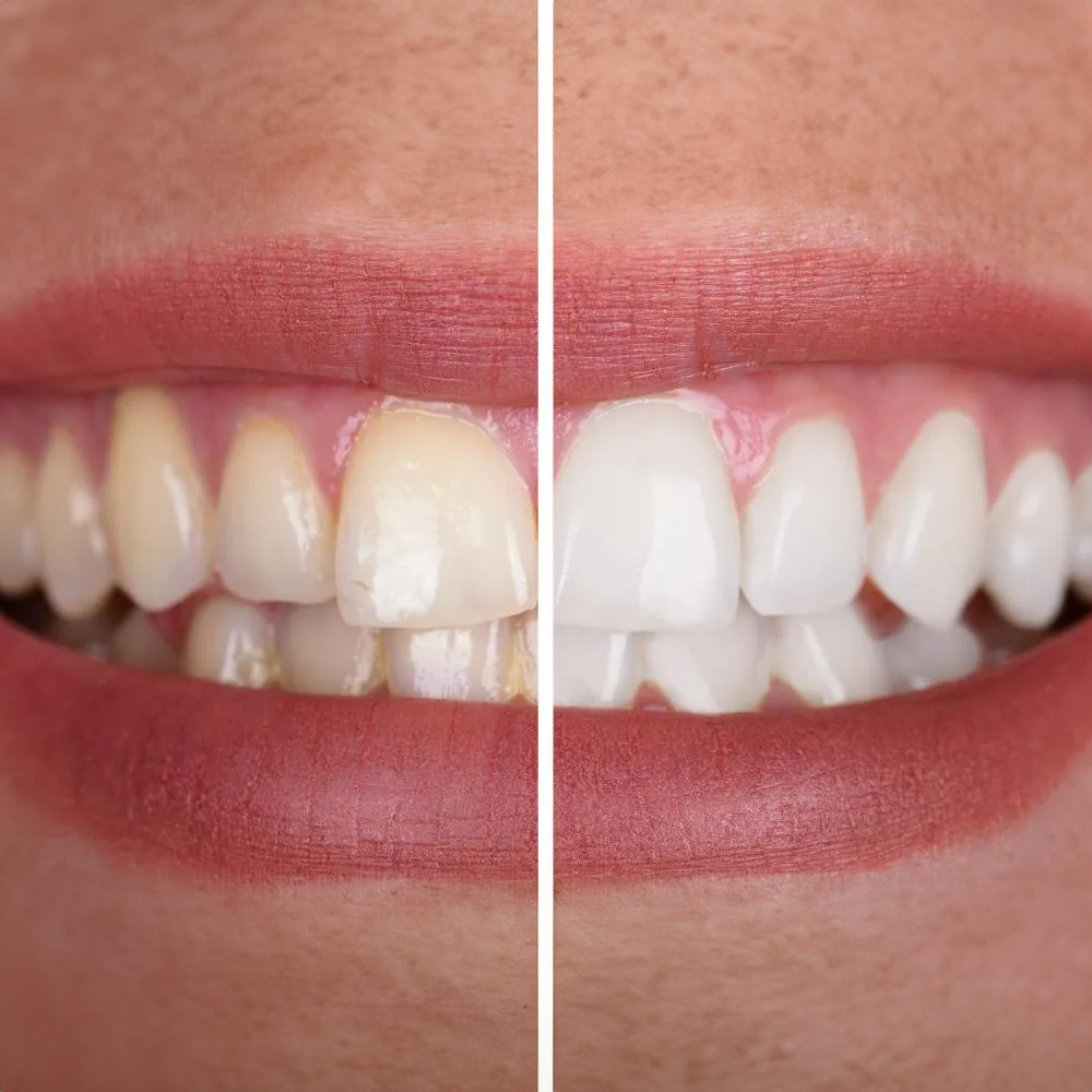 Purelywhite - Teeth Whitening Powder