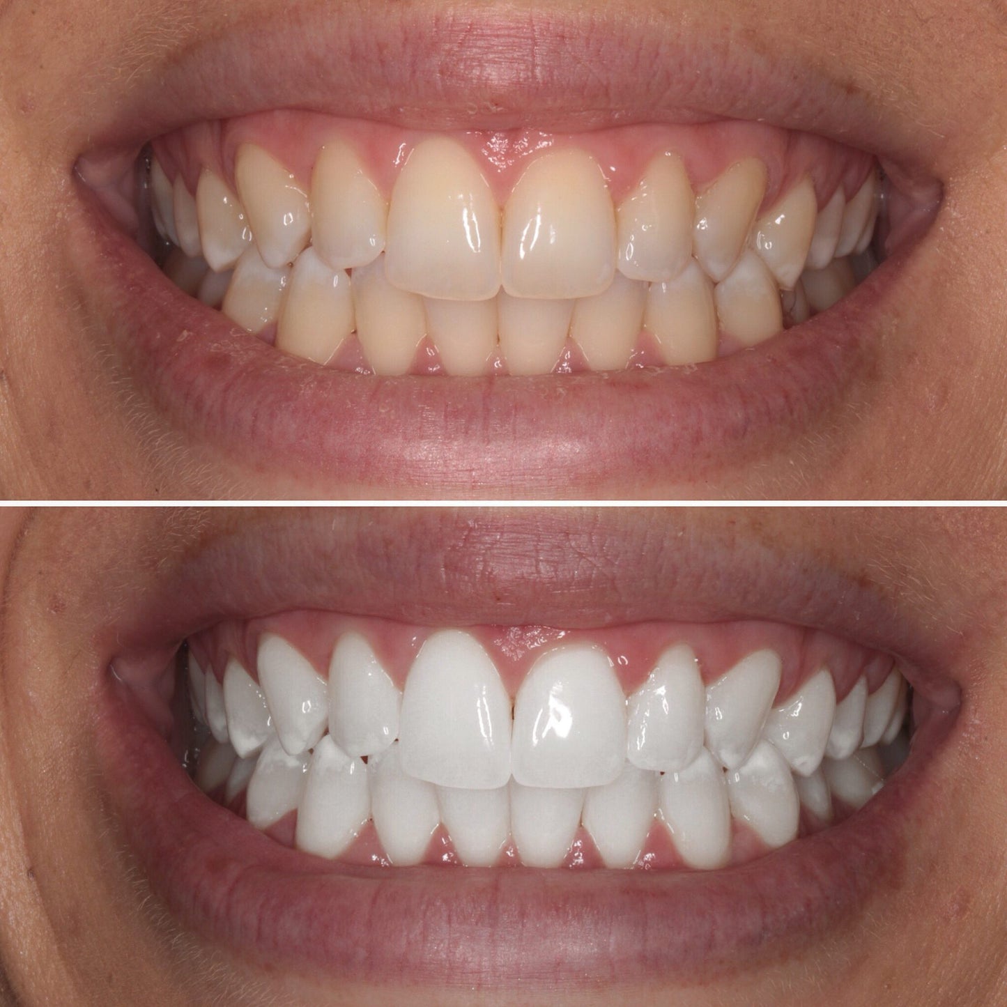 Purelywhite - Teeth Whitening Powder