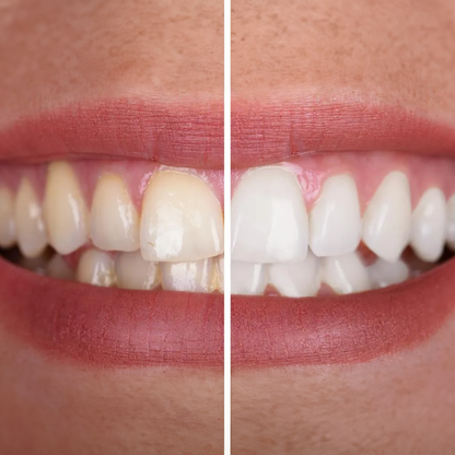 Purelywhite - Teeth Whitening Powder