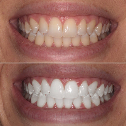 Purelywhite - Teeth Whitening Powder